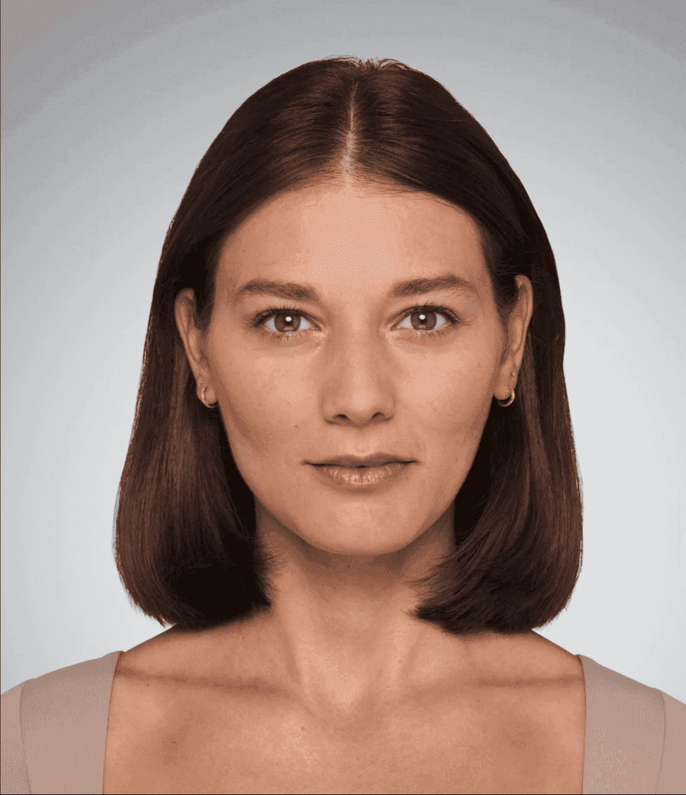 Before full facial balancing with dermal fillers