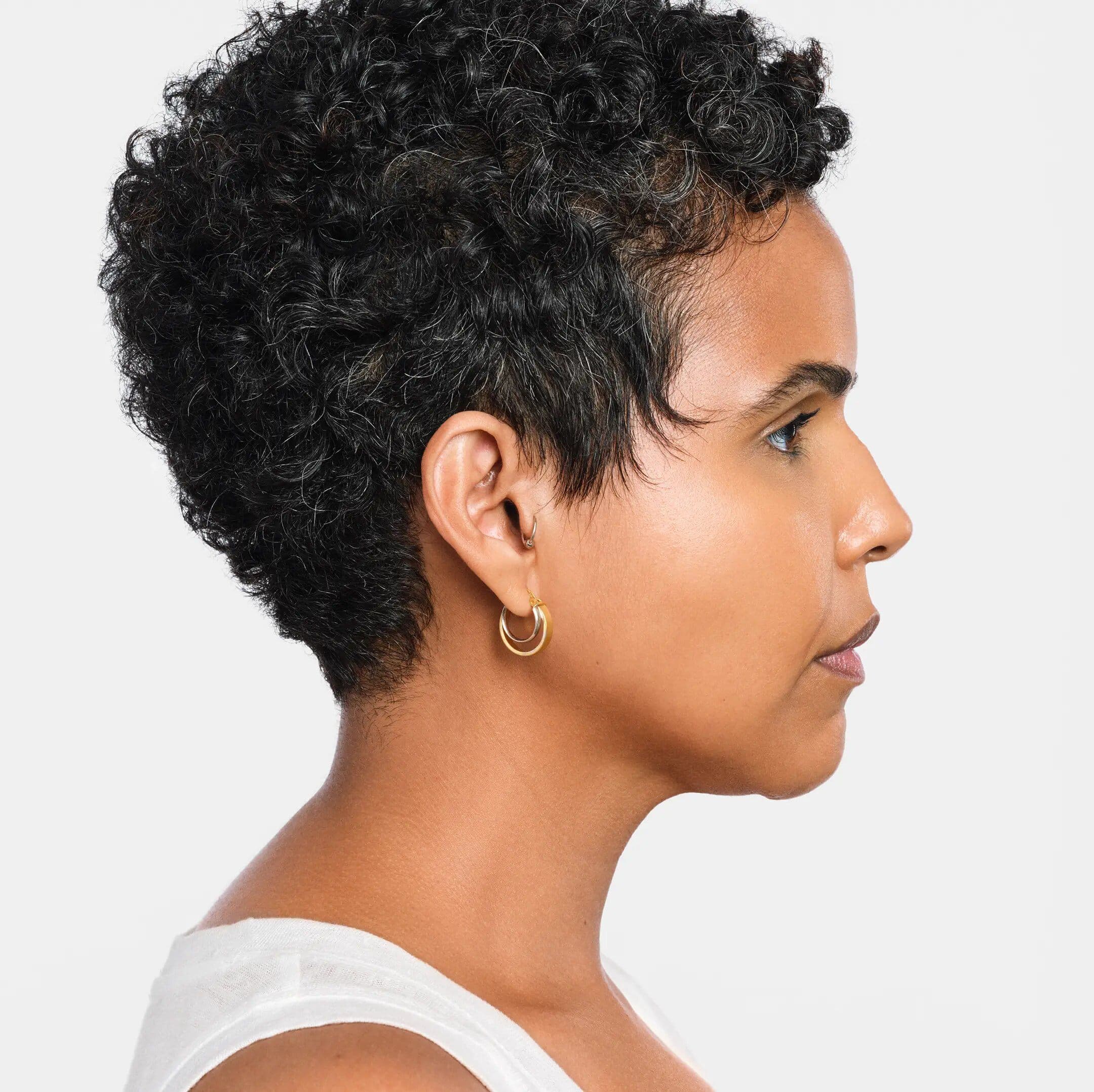 After Radiesse treatment