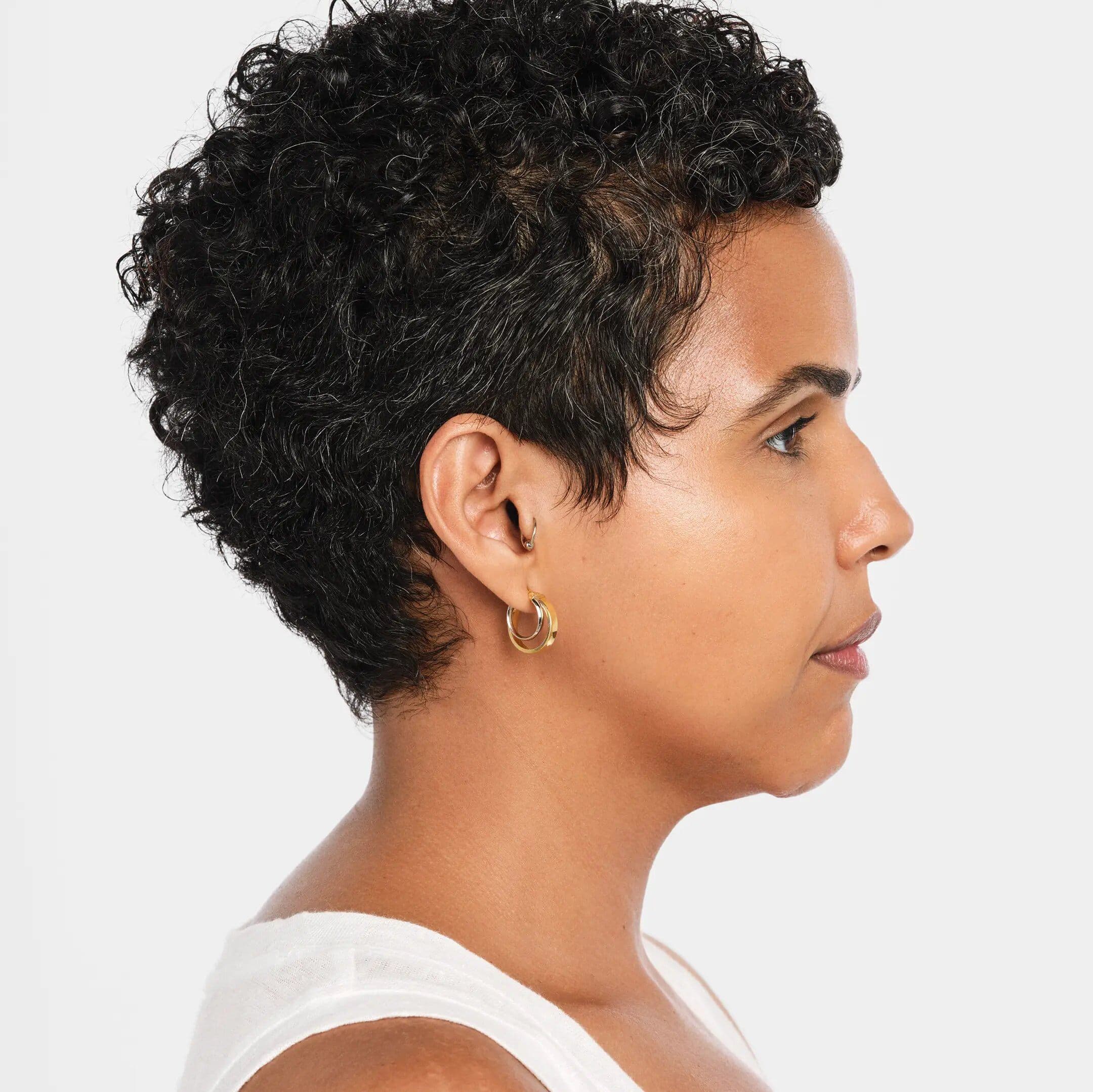 Before Radiesse treatment