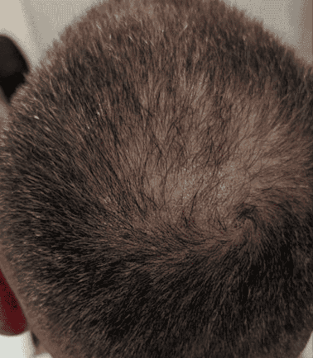 After hair restoration microneedling treatment