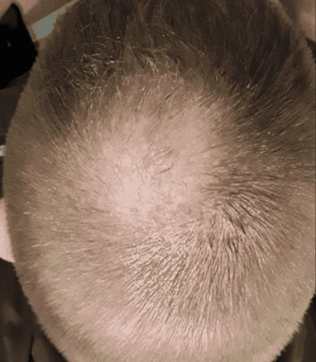 Before hair restoration microneedling treatment