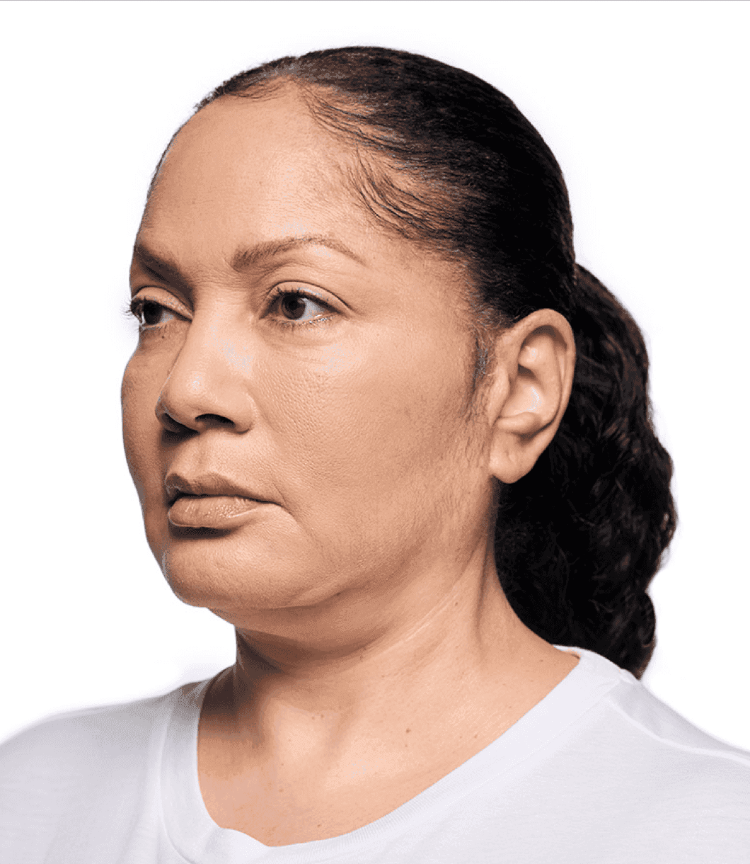 After lip filler treatment