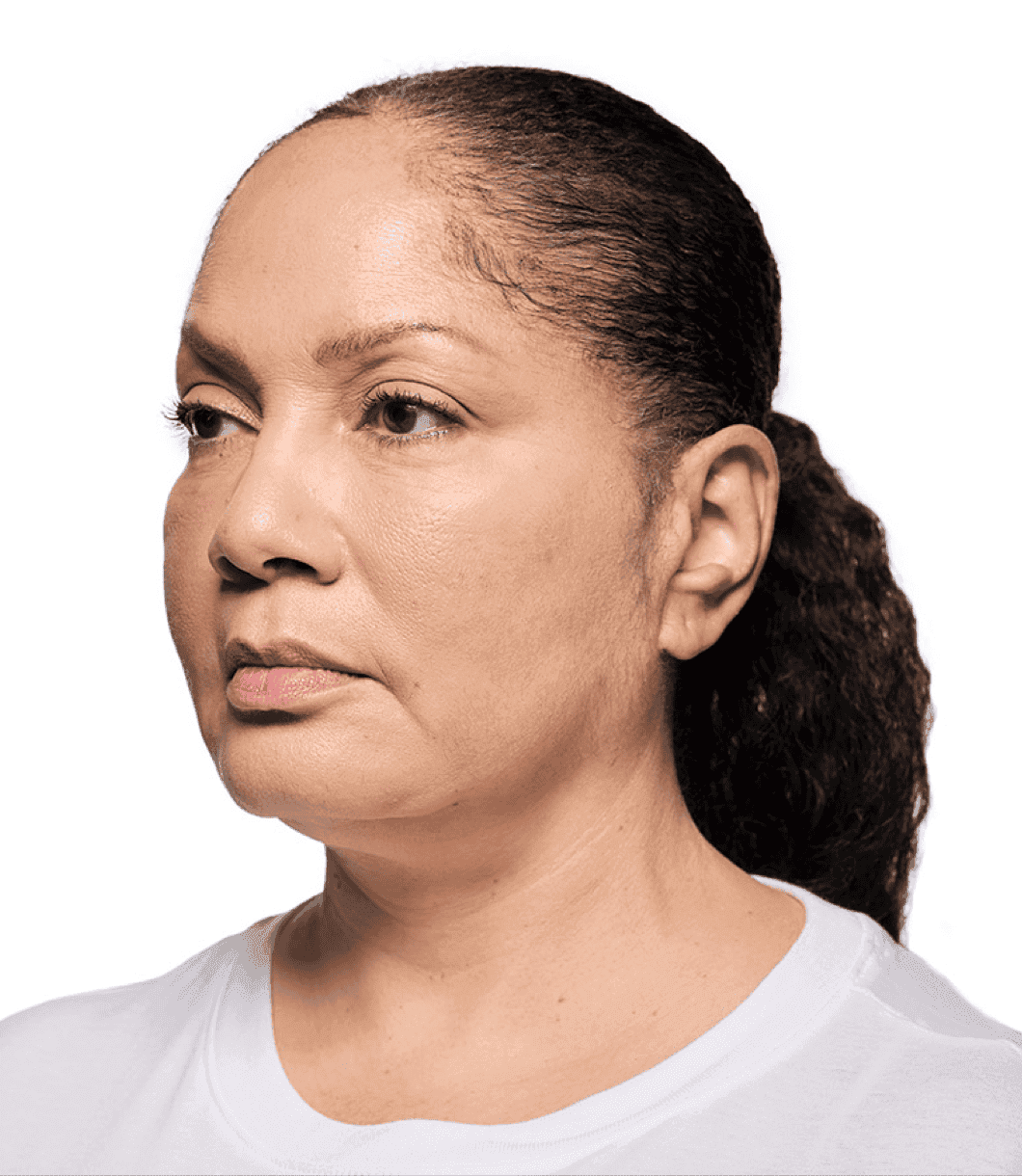 Before lip filler treatment