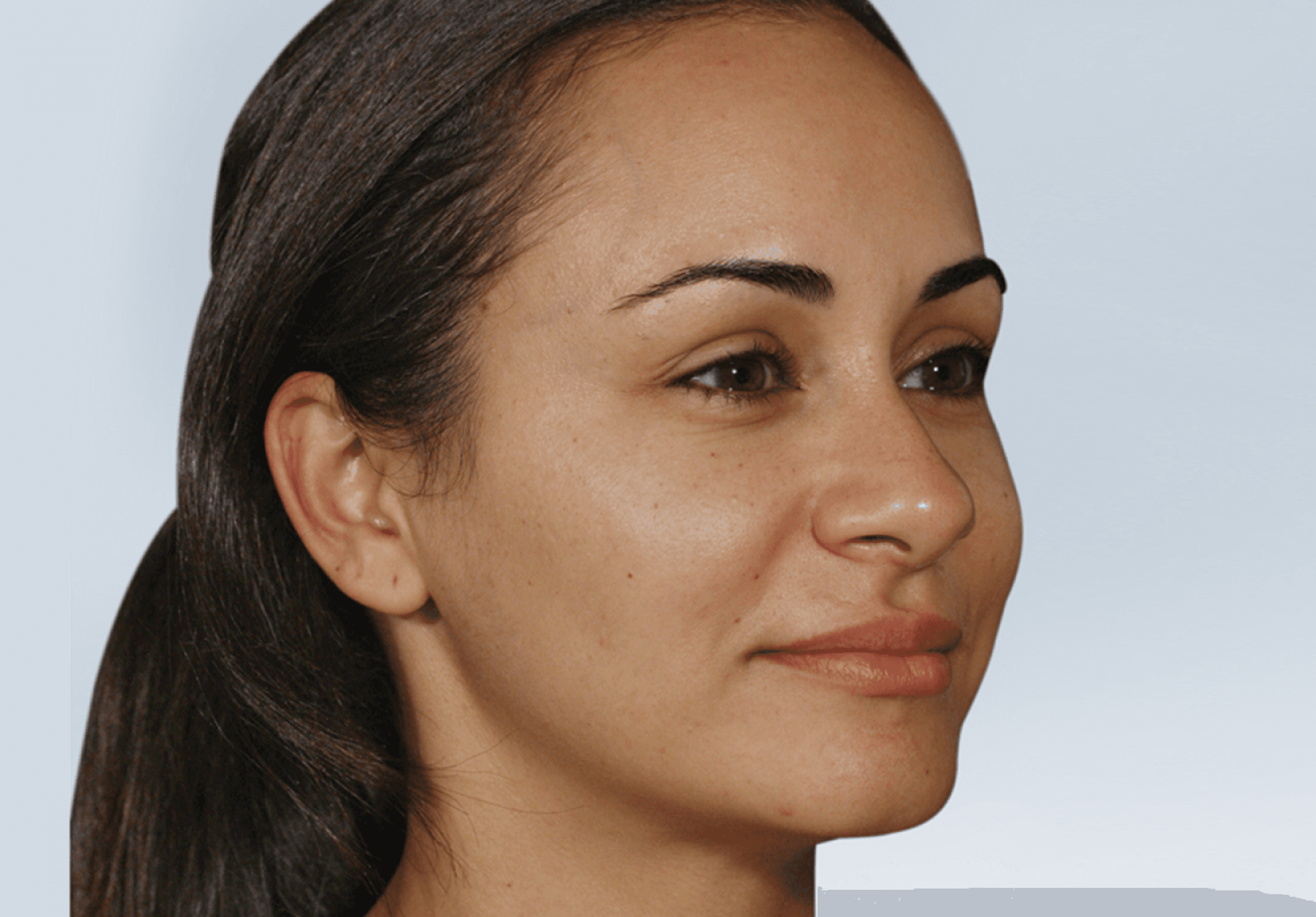 Sculptra treatment results