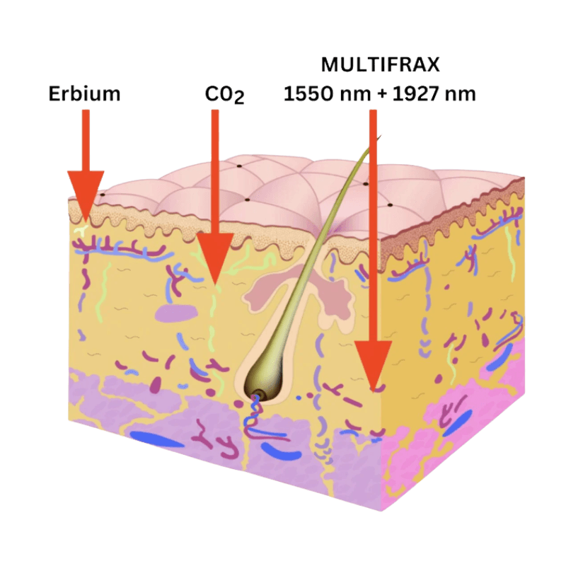 Cross-section diagram of skin showing the penetration depth of the MultiFrax 1550nm and 1927nm wavelengths alongside Erbium and CO2 lasers