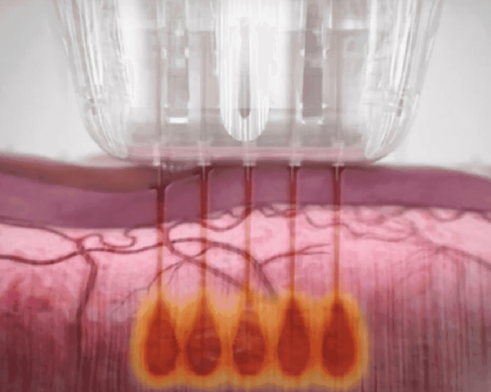 Secret RF microneedling radiofrequency treatment diagram showing needle depth and energy delivery