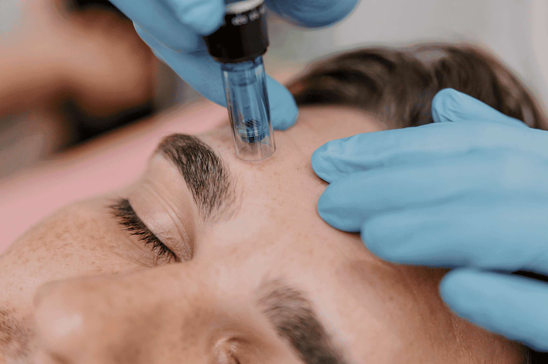 SkinPen microneedling treatment at Manushka Aesthetics
