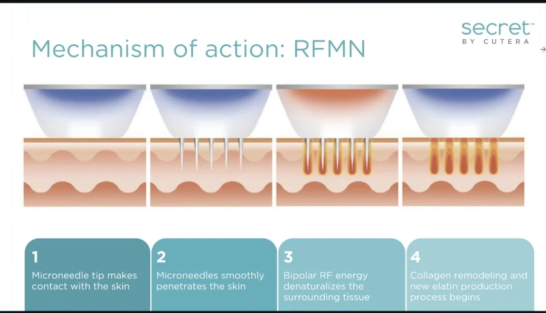 Radiofrequency microneedling staten island