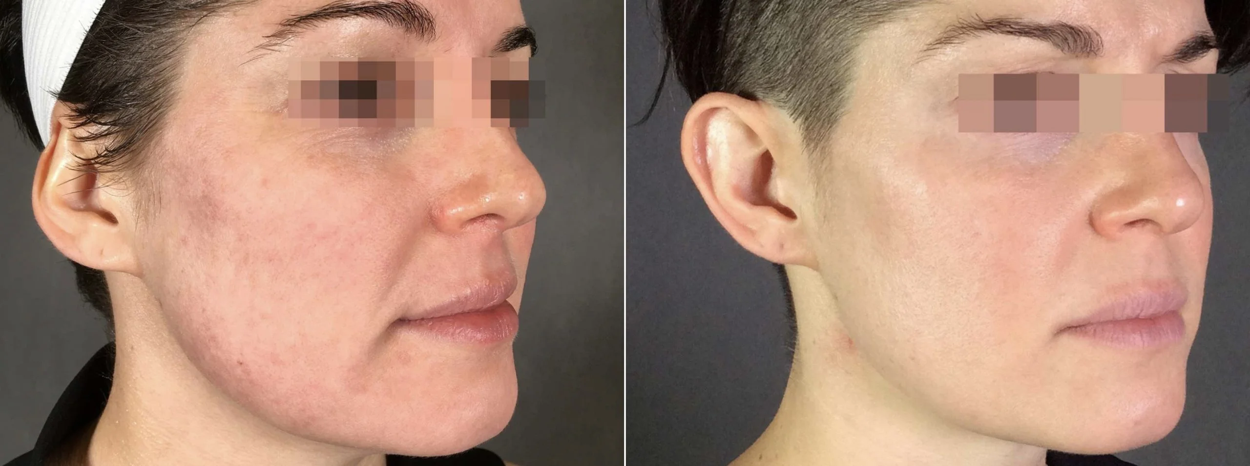 SecretRF Microneedling